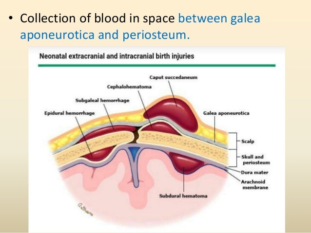 subgaleal hemorrhage subgaleal hemorrhage