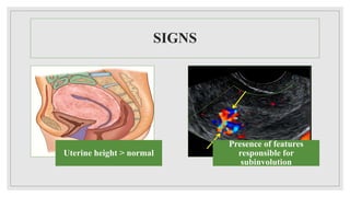 SIGNS
Uterine height > normal
Presence of features
responsible for
subinvolution
 
