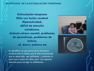Estimulación temprana
Niño con lesión cerebral
Hiperactividad,
déficit de atención
estrabismo,
dislexia retraso mental, problemas
de aprendizaje, problemas de
lectura,
sd. down, autismo etc.
Es identificar en que parte de la estructura
cerebral esta la lesión, que le esta ocasionando
que su desarrollo sea deficiente y estimular lo
igual que a todos los niños, pero con especial
atención para corregir la deficiencia.
 