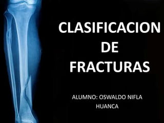 CLASIFICACION
DE
FRACTURAS
ALUMNO: OSWALDO NIFLA
HUANCA
 