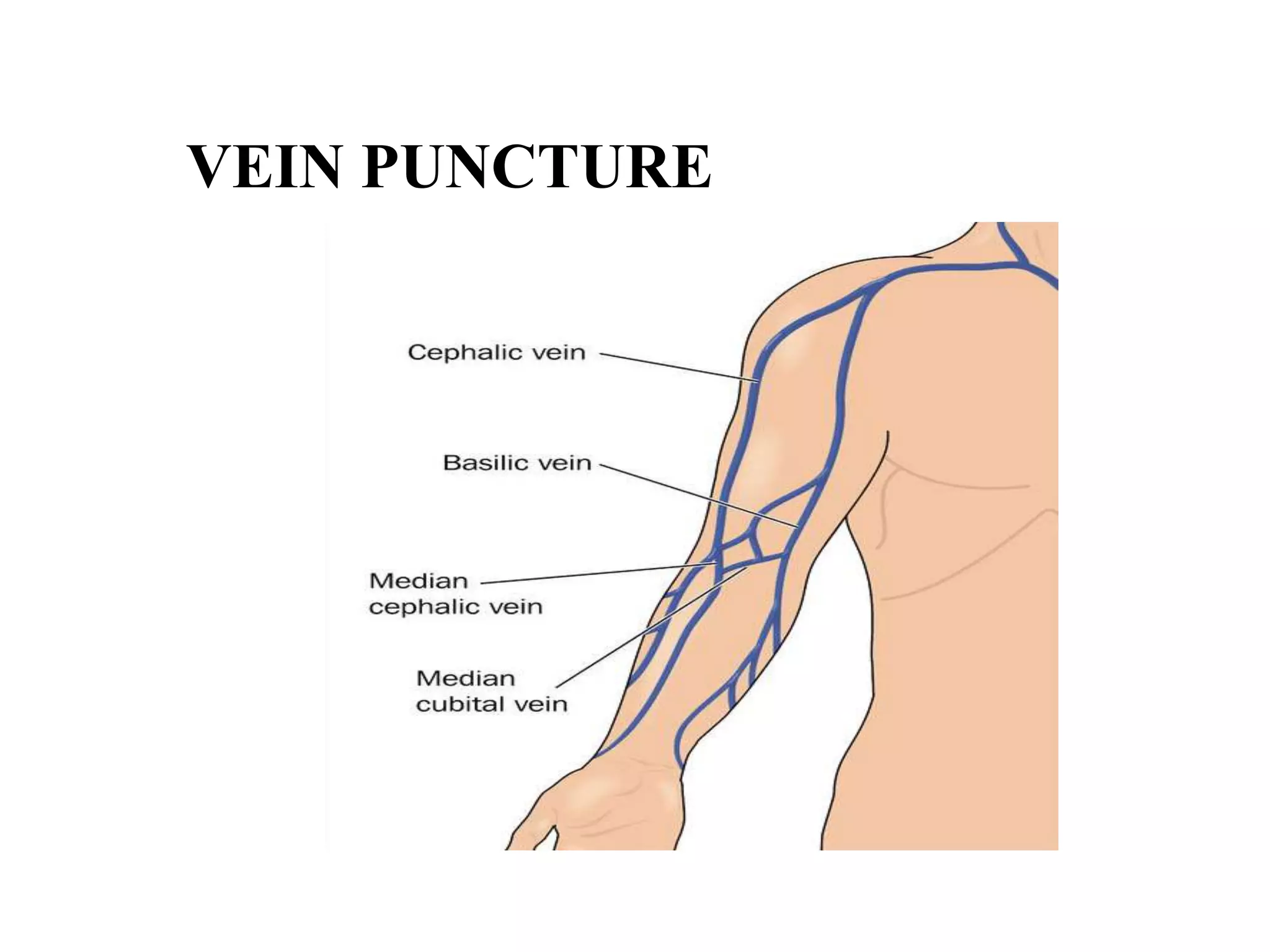 VEIN PUNCTURE
 