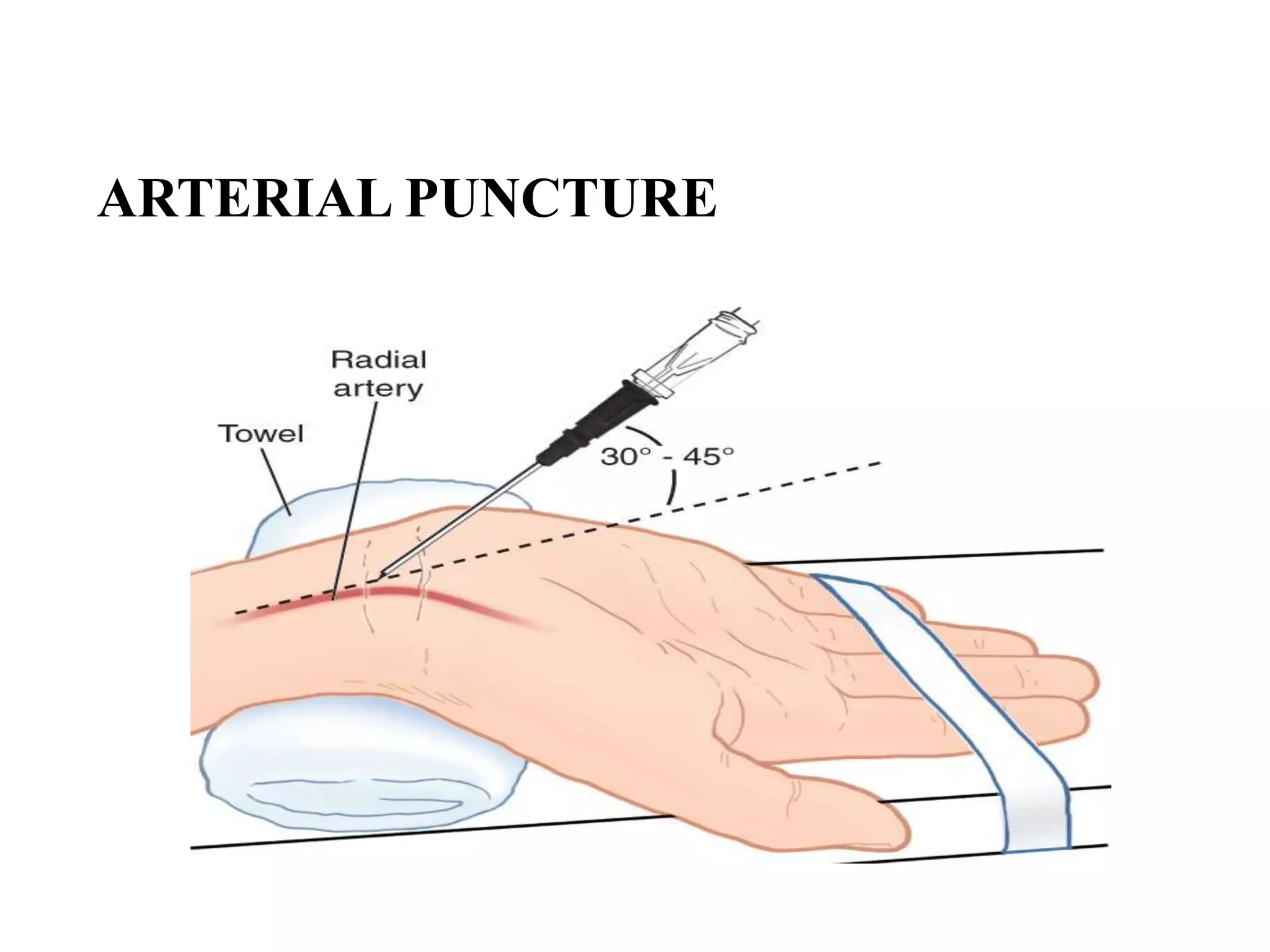 ARTERIAL PUNCTURE
 