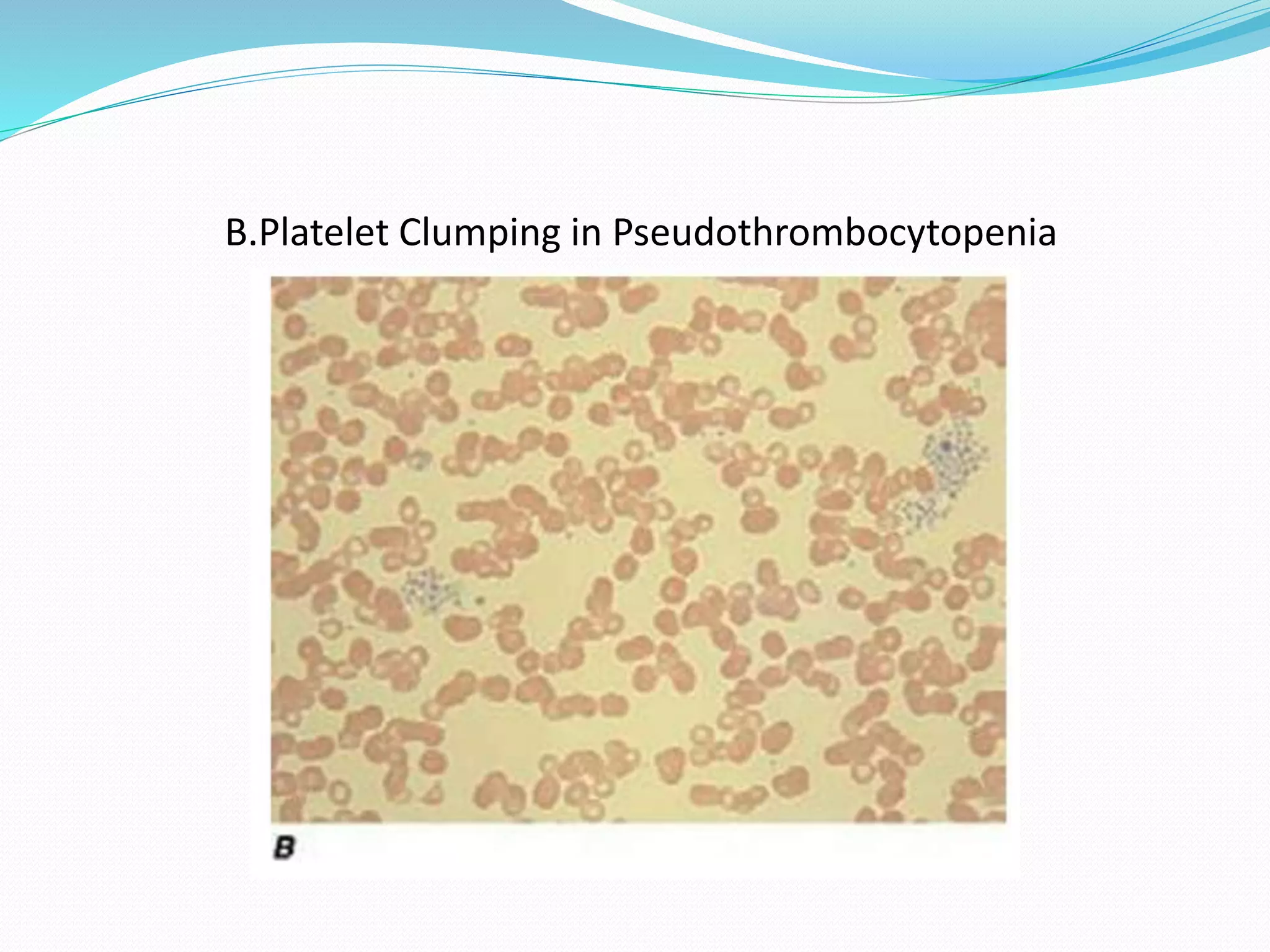 B.Platelet Clumping in Pseudothrombocytopenia
 