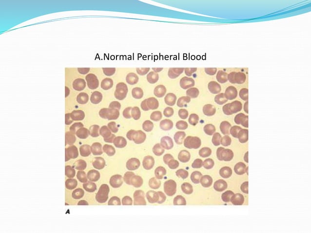 Approach to patient with platelet disorders | PPTX