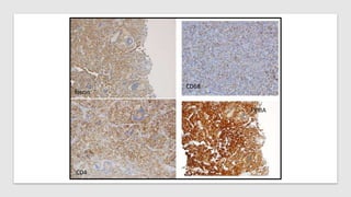 fascin
CD68
CD4
FXIIIA
 