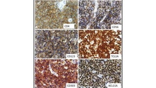 CD4
CD303
CD56
TCL1ACD123
BCL11A
 