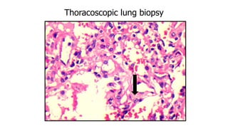 Thoracoscopic lung biopsy
 
