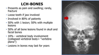 LCH-BONES
• Presents as pain and swelling; rarely,
fracture
• Loose teeth if jaw involved
• Involved in 80% of patients
• 50% with 1 lesion; 50% with multiple
lesions
• 50% of all bone lesions found in skull and
facial bones
• 10% - vertebral body involvement
(collapsed vertebral body= “vertebra
plana”)
• Lesions in bones may last for years
 
