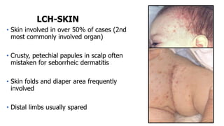 LCH-SKIN
• Skin involved in over 50% of cases (2nd
most commonly involved organ)
• Crusty, petechial papules in scalp often
mistaken for seborrheic dermatitis
• Skin folds and diaper area frequently
involved
• Distal limbs usually spared
 