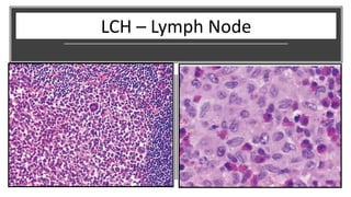 LCH – Lymph Node
 