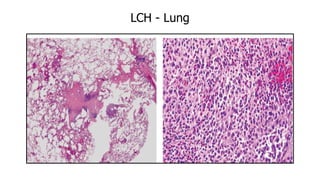 LCH - Lung
 
