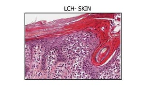 LCH- SKIN
 