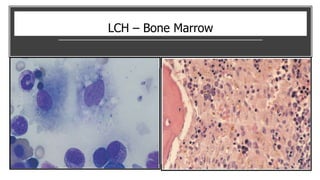 LCH – Bone Marrow
 