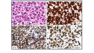 S100
CD1a Langerin
 