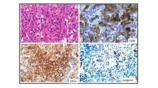 S100
CD1a Langerin
 