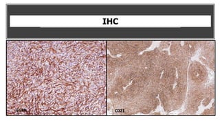 IHC
EGFR CD21
 