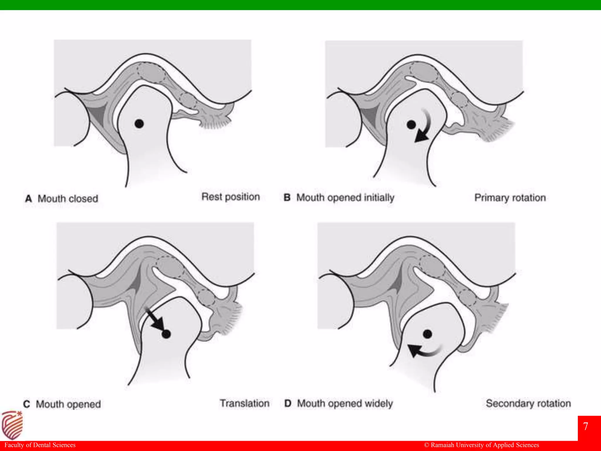Subluxation and dislocation of temporomandibular joint | PPTX