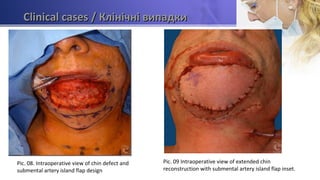 Clinical casesClinical cases / Клінічні випадки/ Клінічні випадки
Pic. 08. Intraoperative view of chin defect and
submental artery island flap design
Pic. 09 Intraoperative view of extended chin
reconstruction with submental artery island flap inset.
 