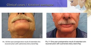 Clinical casesClinical cases / Клінічні випадки/ Клінічні випадки
Pic. 10 One-year postoperative result of extended chin
reconstruction with submental artery island flap
Pic.11 One-year postoperative result of extended chin
reconstruction with submental artery island flap
 