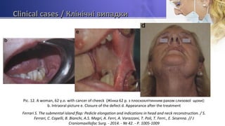 Clinical casesClinical cases / Клінічні випадки/ Клінічні випадки
Pic. 12. A woman, 62 y.o. with cancer of cheeck (Жінка 62 р. з плоскоклітинним раком слизової щоки):
b. Intraoral picture e. Closure of the defect d. Appearance after the treatment
Ferrari S. The submental island flap: Pedicle elongation and indications in head and neck reconstruction. / S.
Ferrari, C. Copelli, B. Bianchi, A.S. Magri, A. Ferri, A. Varazzani, T. Poli, T. Ferri., E. Sesenna. // J
Craniomaxillofac Surg. - 2014. - № 42. - P. 1005-1009
 