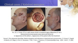 Clinical cases / Клінічні випадки
Pic. 13. a. A man, 57 y.o. with cancer of skin in temporal region (Мужчина 57 лет с
базальноклеточным раком кожи височной области)
b. Appearance of the defect c. Appearance of the patient after the treatment
Ferrari S. The submental island flap: Pedicle elongation and indications in head and neck reconstruction. / S. Ferrari, C. Copelli,
B. Bianchi, A.S. Magri, A. Ferri, A. Varazzani, T. Poli, T. Ferri., E. Sesenna. // J Craniomaxillofac Surg. - 2014. - № 42. - P. 1005-
1009
 