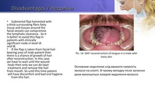 DisadvantagesDisadvantages / Недоліки/ Недоліки
• Submental flap harvested with
a thick surrounding fibro fatty
tissue and tissues around the
facial vessels can compromise
the lymphatic clearance. So it
is better to avoid this flap in
patients with clinically
significant node in level IA
and IB.
• If the flap is taken from facial hair
bearing area of male patient then
there is a chance of growth of hair
after reconstruction. In this case
we have to wait until the wound
heals then only we can do laser
treatment and remove the hair
from mouth. So until this time patient
will have discomfort and bad oral hygiene
from this hair.
Pic. 14. SAIF reconstruction of tongue in a male with
hairy skin
Основним недоліком слід вважати наявність
волосся на клапті. В такому випадку після загоєння
рани виконується лазерне видалення волосся.
 