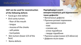 IndicationsIndications / Покази/ Покази
SAIF can be used for reconstruction
of the following defects
• Facial gun shot defect
• Oral cavity tumors
- floor of the mouth
- tongue
- mucosa of the cheeks
- soft palate
- hard palate
• Skin tumors (lower 2/3 of the
face)
• Noma defects
Підпідборідні клапті
використовуються для відновлення
таких дефектів:
• Вогнепальні дефекти
• Пухлини ротової порожнини
- дно порожнини рота
- язик
- слизова щік
- м'яке піднебіння
- тверде піднебіння
• Пухлини шкіри (нижні 2/3 обличчя)
• Дефекти після номи
 