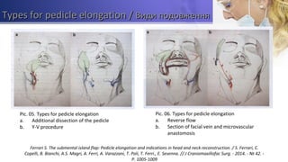 Types for pedicle elongationTypes for pedicle elongation // Види подовженняВиди подовження
Pic. 05. Types for pedicle elongation
a. Additional dissection of the pedicle
b. Y-V procedure
Pic. 06. Types for pedicle elongation
a. Reverse flow
b. Section of facial vein and microvascular
anastomosis
Ferrari S. The submental island flap: Pedicle elongation and indications in head and neck reconstruction. / S. Ferrari, C.
Copelli, B. Bianchi, A.S. Magri, A. Ferri, A. Varazzani, T. Poli, T. Ferri., E. Sesenna. // J Craniomaxillofac Surg. - 2014. - № 42. -
P. 1005-1009
 