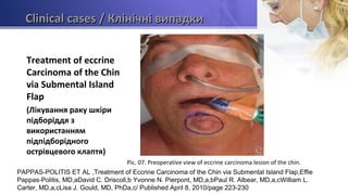 Clinical casesClinical cases / Клінічні випадки/ Клінічні випадки
Treatment of eccrine
Carcinoma of the Chin
via Submental Island
Flap
(Лікування раку шкіри
підборіддя з
використанням
підпідборідного
острівцевого клаптя)
Pic. 07. Preoperative view of eccrine carcinoma lesion of the chin.
PAPPAS-POLITIS ET AL ,Treatment of Eccrine Carcinoma of the Chin via Submental Island Flap,Effie
Pappas-Politis, MD,aDavid C. Driscoll,b Yvonne N. Pierpont, MD,a,bPaul R. Albear, MD,a,cWilliam L.
Carter, MD,a,cLisa J. Gould, MD, PhDa,c/ Published April 8, 2010/page 223-230
 