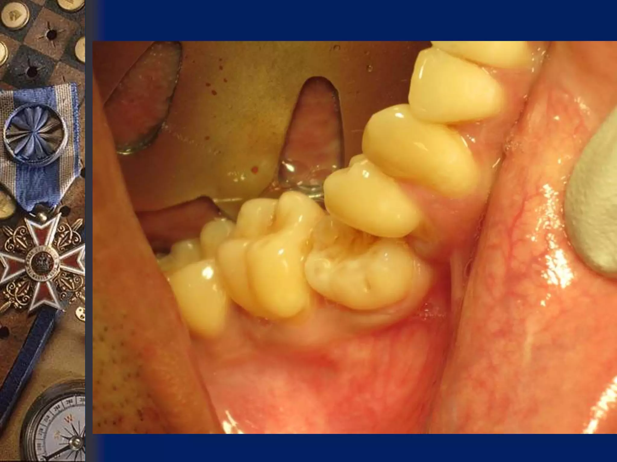 Ankylosis Of Teeth PPT Ankylosis of teeth ppt