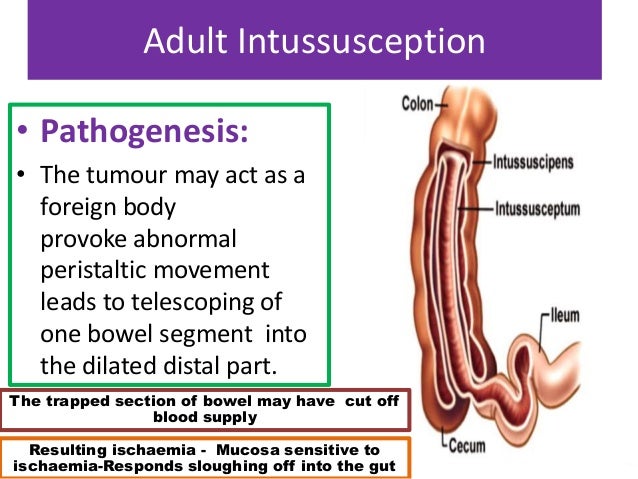Intussusception in Adults-Submucosal Lipoma at Transverse colon-A ra… Intussusception in Adults-Submucosal Lipoma at Transverse colon-A ra…