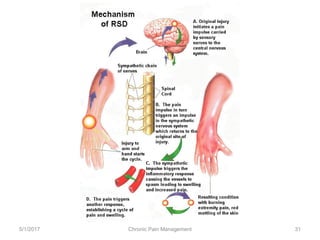5/1/2017 Chronic Pain Management 31
 