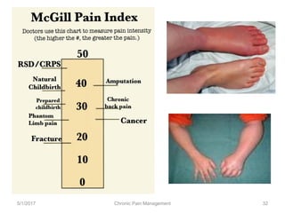 5/1/2017 Chronic Pain Management 32
 