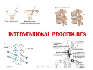 INTERVENTIONAL PROCEDURES
5/1/2017 64Chronic Pain Management
 