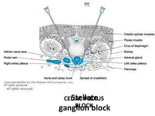Stellate
ganglion block
CELIAC PLEXUS
BLOCK
 