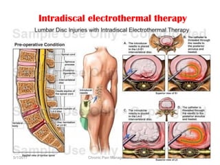 Intradiscal electrothermal therapy
5/1/2017 78Chronic Pain Management
 
