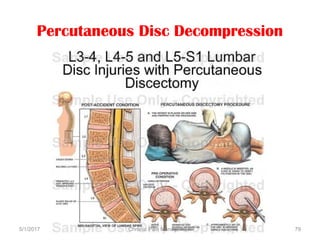 Percutaneous Disc Decompression
5/1/2017 79Chronic Pain Management
 