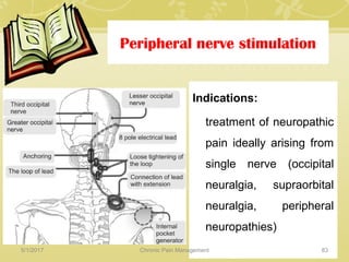 Peripheral nerve stimulation
Indications:
treatment of neuropathic
pain ideally arising from
single nerve (occipital
neuralgia, supraorbital
neuralgia, peripheral
neuropathies)
5/1/2017 83Chronic Pain Management
 