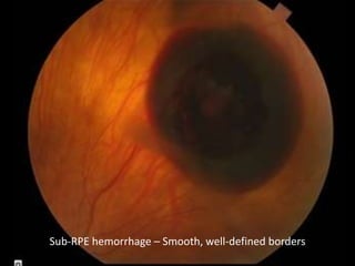 Sub Rpe Hemorrhage