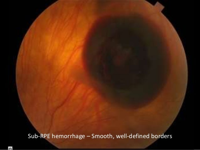 Sub RPE Hemorrhage Smooth Well Defined Borders Sub RPE Hemorrhage Smooth Well Defined Borders