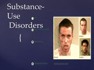 {
Substance-
Use
Disorders
 