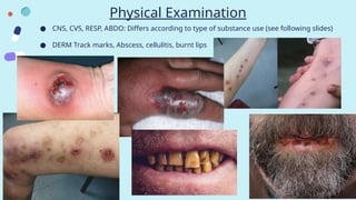 Physical Examination
● CNS, CVS, RESP, ABDO: Differs according to type of substance use (see following slides)
● DERM Track marks, Abscess, cellulitis, burnt lips
 