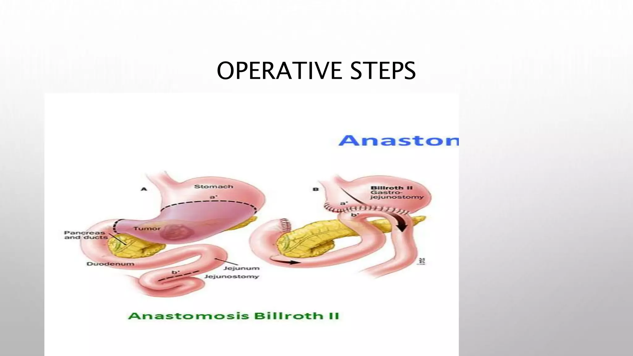 subtotal gastrectomy with gastrojejunostomy.pptx