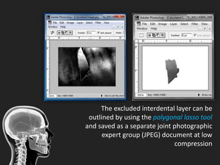 Subtraction radiography and morphometric analysis in periodontics | PPTX