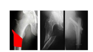 Subtrochanteric fracture | PPTX