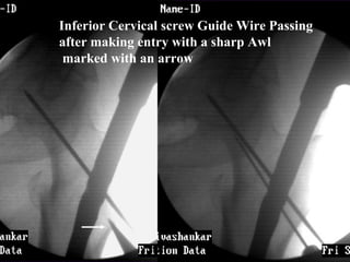 Sub trochanteric fractre nailing in lateral position | PPT