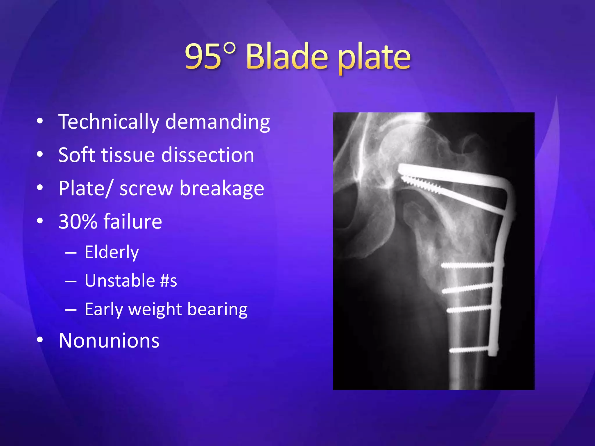 •   Technically demanding
•   Soft tissue dissection
•   Plate/ screw breakage
•   30% failure
    – Elderly
    – Unstable #s
    – Early weight bearing
• Nonunions
 