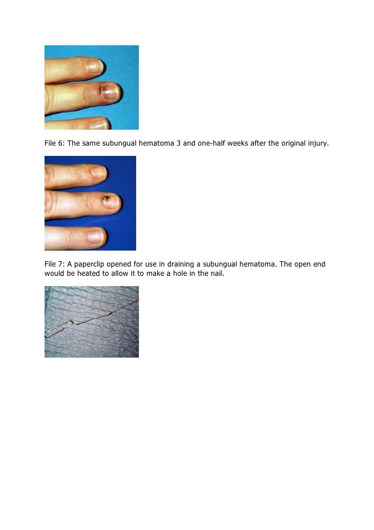 Subungual Hematoma
