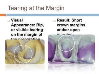 Tearing at the Margin
   Visual                  Result: Short
    Appearance: Rip,         crown margins
    or visible tearing       and/or open
    on the margin of         margins.
    the preparation.
 