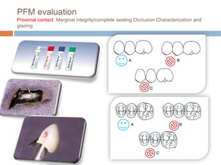 PFM evaluation
Proximal contact Marginal integrity/complete seating Occlusion Characterization and
glazing
 